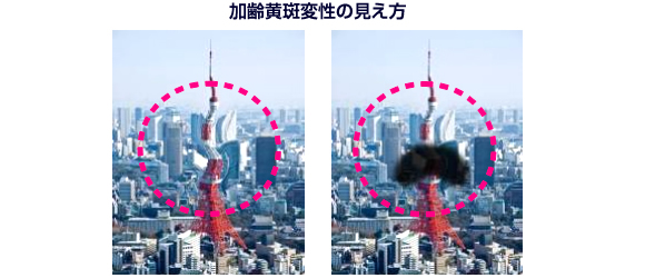 加齢黄斑変性の見え方